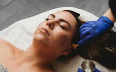 Glycolic Peel Calgary, Burnaby & Edmonton