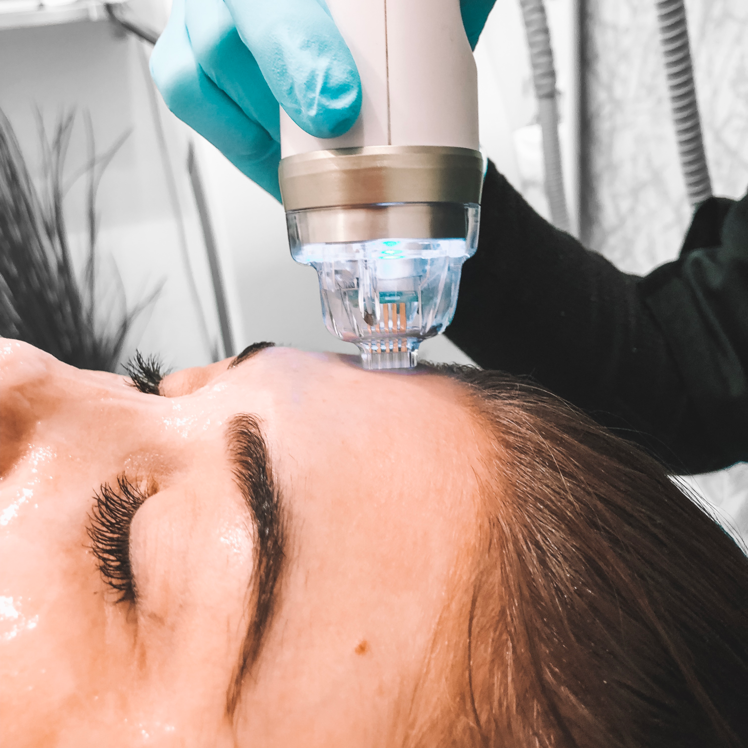 Woman receiving microneedling on forehead