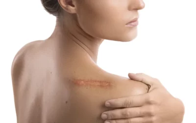 Keloid Treatment - Plastic Surgery Vancouver, Rejuvenation Coal Harbour, Dr. Diana Forbes
