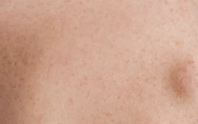 Lipoma Removal - Plastic Surgery Vancouver, Rejuvenation Coal Harbour, Dr. Diana Forbes
