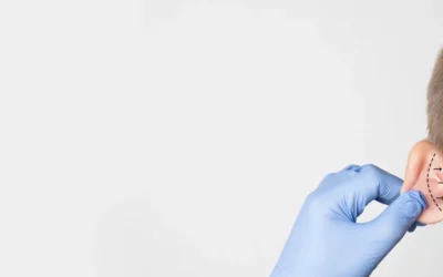 Otoplasty - Plastic Surgery Vancouver, Rejuvenation Coal Harbour, Dr. Diana Forbes