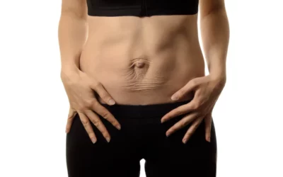Rectus Diastasis Repair - Plastic Surgery Vancouver, Rejuvenation Coal Harbour, Dr. Diana Forbes