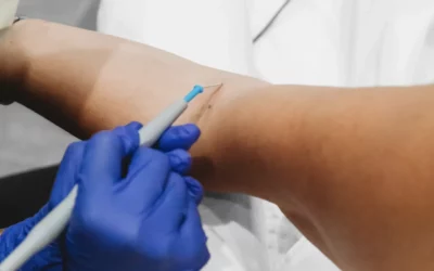 Skin Lesion and Cancer Excision - Plastic Surgery Vancouver, Rejuvenation Coal Harbour, Dr. Diana Forbes