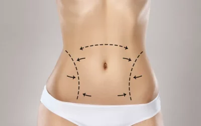 Tummy Tuck - Plastic Surgery Vancouver, Rejuvenation Coal Harbour, Dr. Diana Forbes