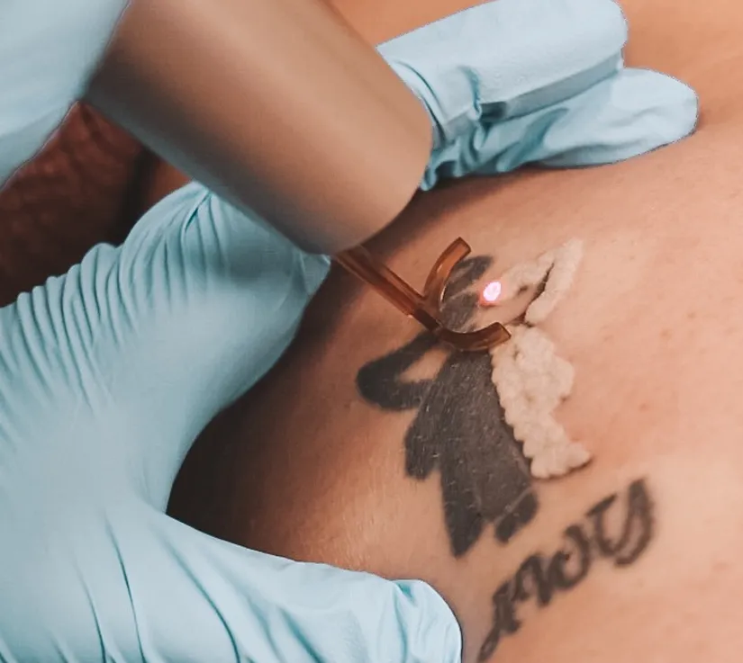 Tattoo Removal with PicoWay ® - Rejuvenation Clinic