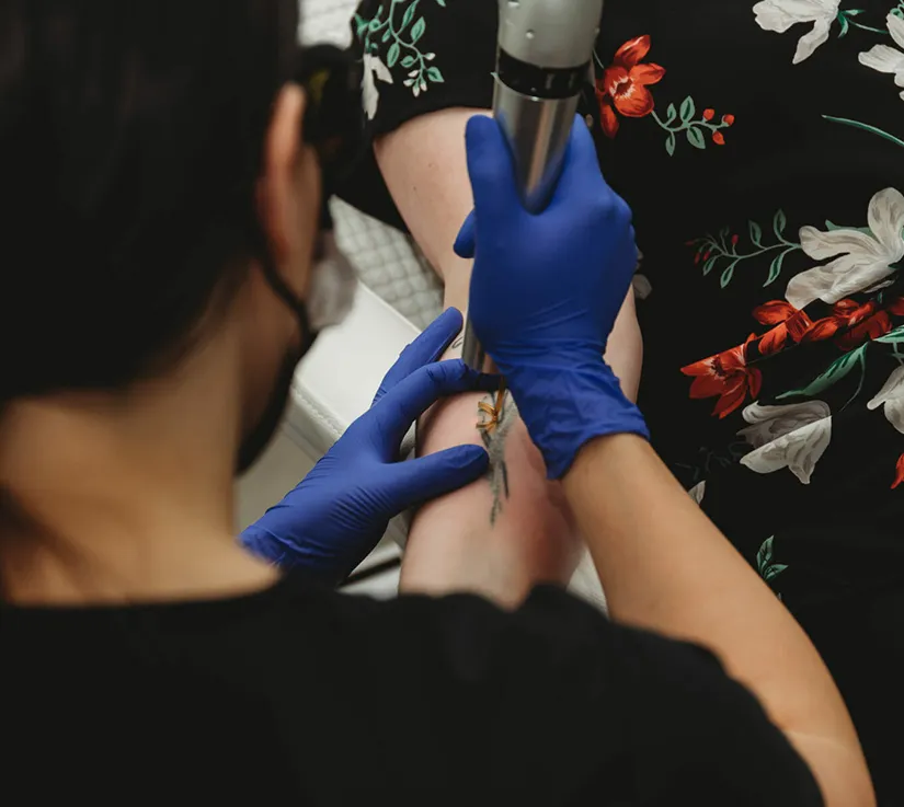 tattoo Removal with PicoWay ® - Rejuvenation Clinic